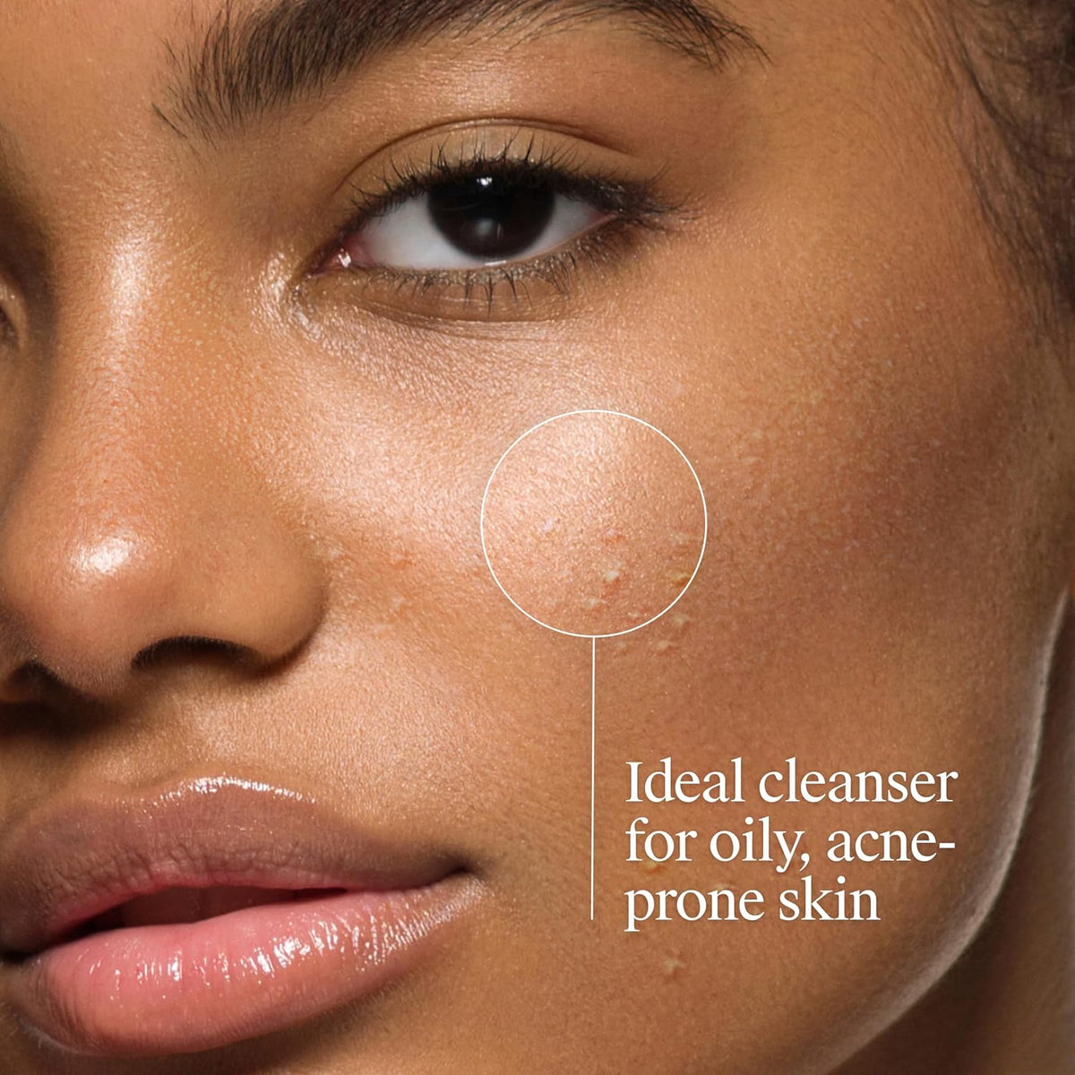 Oil Free Acne Face Wash, 6 Fl. Oz
